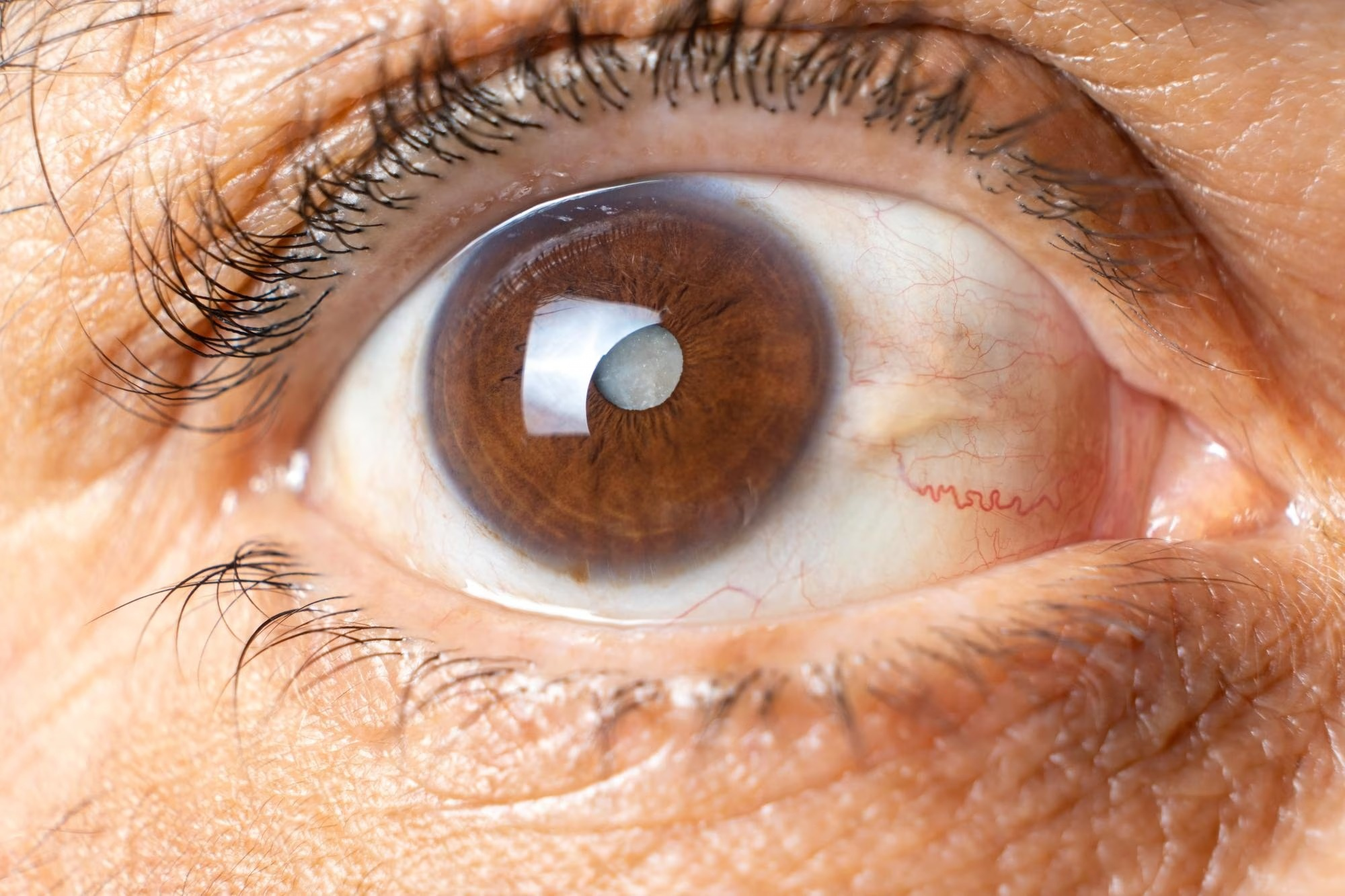 Cirugía de glaucoma tratamiento quirúrgico