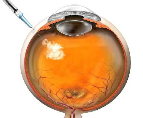Inyección intravítrea anti-VEGF tratamiento retina