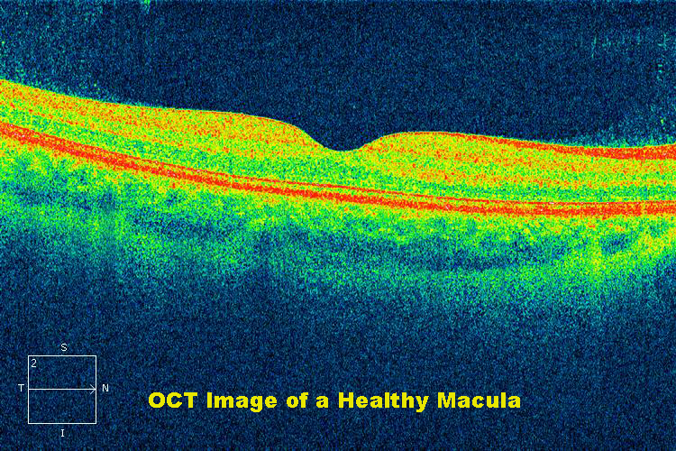 OCT Tomografía de Coherencia Óptica de retina y mácula