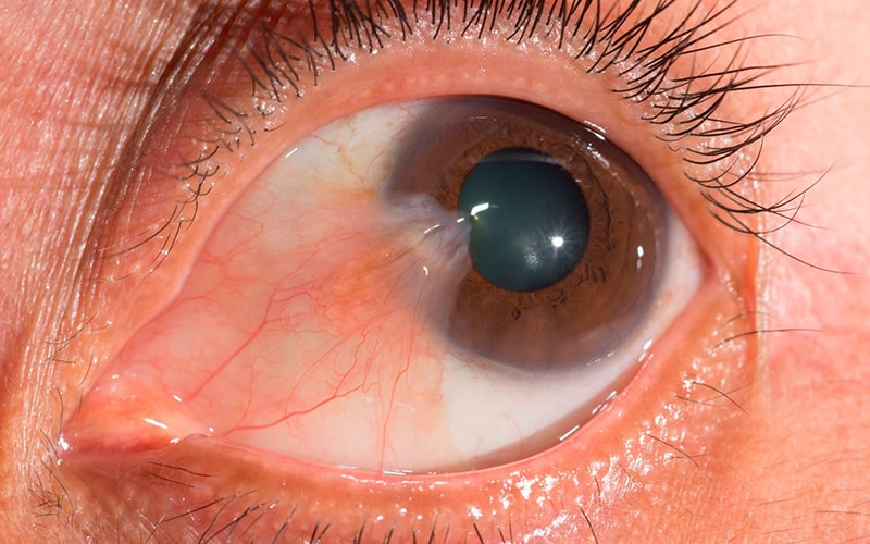 Pterigión carnosidad del ojo cirugía