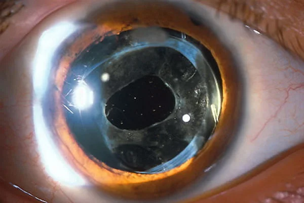 YAG láser capsulotomía posterior tratamiento